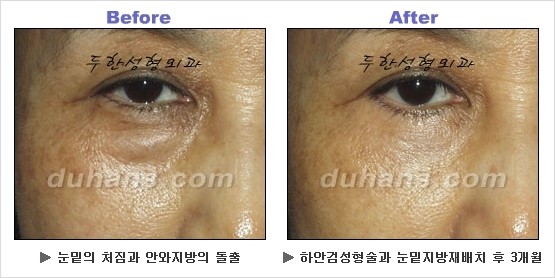 [두한성형외과 경쟁력 동안성형 리더] - ​[미간주름, 이마주름, 안검성형, 이마거상술, 눈썹거상술] 관련 이미지 68