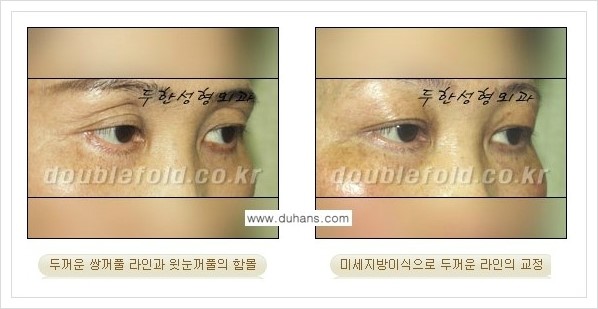 [두한성형외과 경쟁력 눈성형] - [미세지방이식으로 두껍고 어색한 라인 교정 안내 1.] 관련 이미지 12