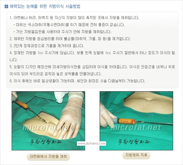 [두한성형외과 경쟁력 눈밑성형] - [눈밑이 전반적으로 함몰된 다크써클 교정 안내] 관련 이미지 1