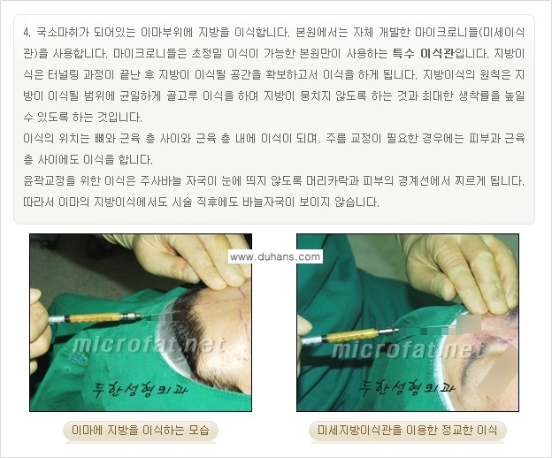 [두한성형외과의 경쟁력 미세지방이식] - [이마 미세지방이식 안내 ①] 관련 이미지 9