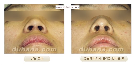 [두한성형외과 경쟁력 코성형] - [코성형을 위한 알로덤(슈어덤) 수술, 실리콘 수술 안내] 관련 이미지 33