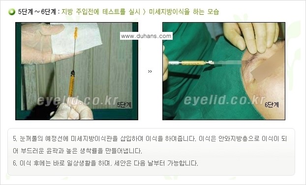 [두한성형외과 경쟁력 미세지방이식] - [꺼진(함몰된) 윗눈꺼풀 미세지방이식] 관련 이미지 7