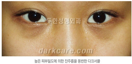 Duhan Plastic Surgery Dark Circle Improvement - What Causes Dark Circles? What Types of Dark Circles Are There? image 9