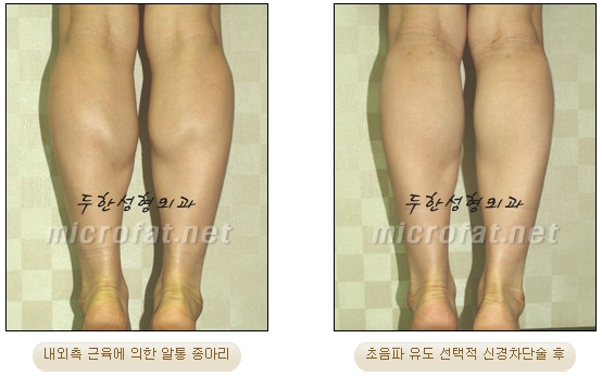 [Duhan Plastic Surgery Clinic Calf Contouring] - [Calf Reduction] image 16