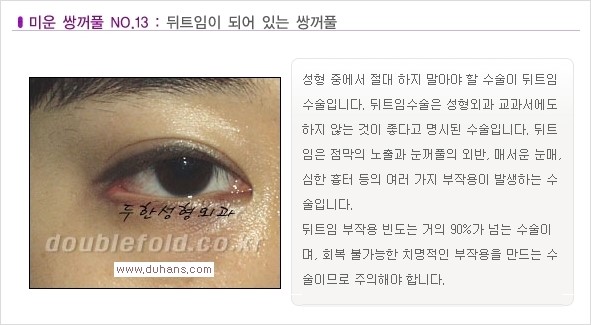 [두한성형외과 경쟁력 쌍꺼풀 재수술, 극한 재수술] - [일반적인 기준의 미운 쌍꺼풀과 아름다운 쌍꺼풀 안내] 관련 이미지 13