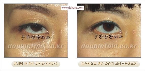 [두한성형외과 경쟁력 눈성형] - [쌍꺼풀 재수술에 대한 최선의 대안 제시] 관련 이미지 83