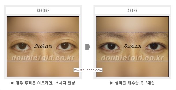 [두한성형외과 쌍꺼풀 재수술, 극한 눈재수술] - [재수술에 대한 자주하는 질문과 답변 안내] 관련 이미지 4