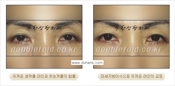 [두한성형외과 NO.1 눈성형] - [함몰된(꺼진) 눈꺼풀에서 쌍꺼풀 라인 교정 2.] 관련 이미지 11