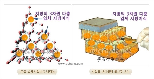 [두한성형외과 경쟁력 미세지방이식] - [3차원 입체지방이식과 2차원 평면지방이식의 차이점] 관련 이미지 1