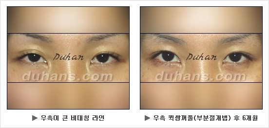 [두한성형외과 쌍커풀수술] - [눈성형 방법에 대한 자주하는 질문과 답변] 관련 이미지 129