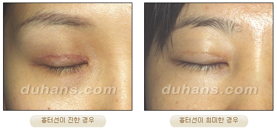 [DuHan Plastic Surgery Eye Surgery] - [Double Eyelid Surgery Guide] image 12