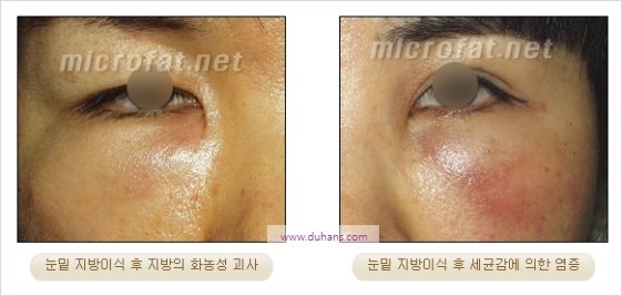 [두한성형외과 경쟁력 지방이식] - [두한 자가지방이식 클리닉 안내]​ 관련 이미지 61