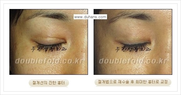 [두한성형외과 경쟁력 쌍꺼풀(눈) 재수술] - [쌍꺼풀 흉터선이 진한 경우의 안내] 관련 이미지 6