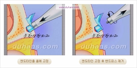 [두한성형외과 주름성형] - [주름교정술 - 강력한 리프팅 파워 엔도타인 리프팅 ] 관련 이미지 32