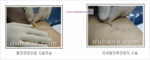 [두한성형외과 경쟁력 정맥류 치료] - [정맥류의 원인, 문제점, 진단방법, 치료방법] 관련 이미지 19