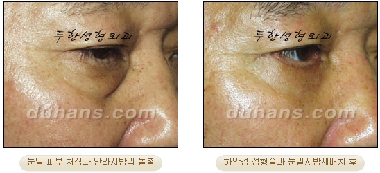 [Duhan Plastic Surgery Ophthalmic Plastic Surgery] - [Lower Blepharoplasty] image 31