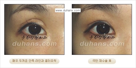 [두한성형외과 경쟁력 눈성형] - [두꺼운 라인을 교정하는 극한 눈 재수술 1.] 관련 이미지 12
