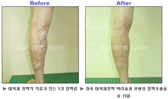 [두한성형외과 정맥류] - [하지정맥류, 정맥확장증, 혈관확장증] 관련 이미지 35