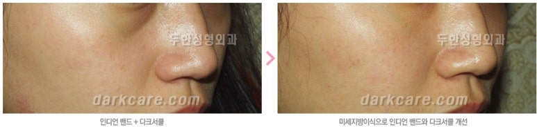 [두한성형외과 자가지방이식] - [인디언주름] 관련 이미지 31