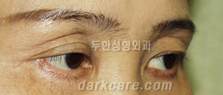 [눈밑수술 두한성형외과] - [다크서클 콤비프로그램] 관련 이미지 42