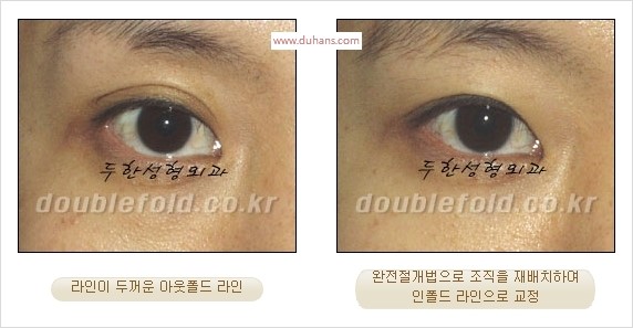 [두한성형외과 경쟁력 눈성형] - [완전절개법(Full incision method)의 재수술 과정] 관련 이미지 12