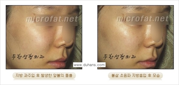 [두한성형외과 경쟁력 지방흡입] - [얼굴, 볼살, 턱살, 턱선의 초음파 지방흡입] 관련 이미지 15