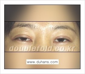 [두한성형외과 경쟁력 눈성형] - [쌍꺼풀 재수술 대상과 쌍꺼풀 재수술에 필요한 검사와 테스트] 관련 이미지 17