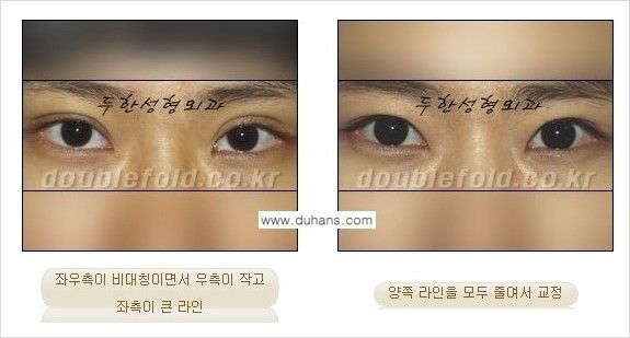 [두한성형외과 경쟁력 쌍꺼풀 재수술] - [짝짝이 쌍꺼풀 라인 교정] 관련 이미지 4