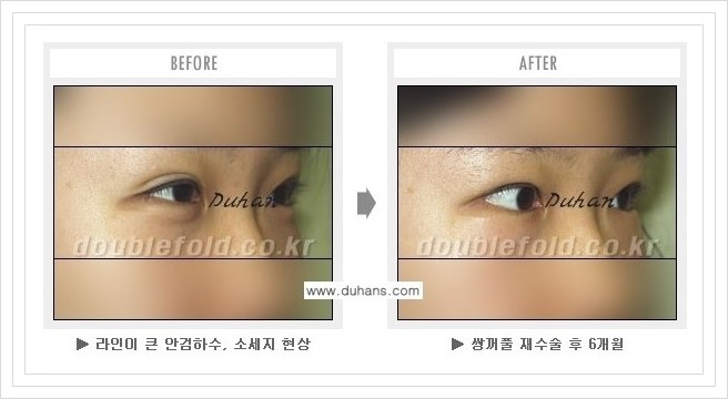 [두한성형외과 경쟁력 쌍꺼풀 재수술, 극한 재수술] - [과한 눈매교정 안내] 관련 이미지 5