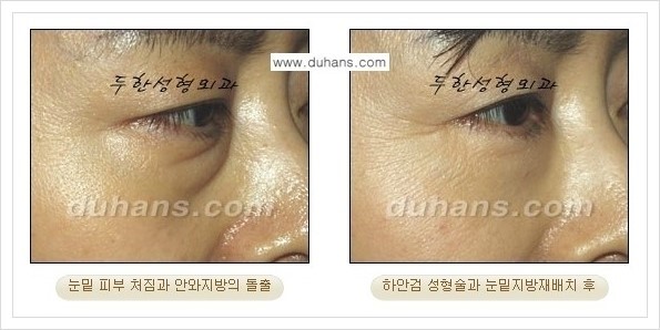 [두한성형외과 경쟁력 눈성형] - [젊은 눈매로의 복원 안검성형] 관련 이미지 40