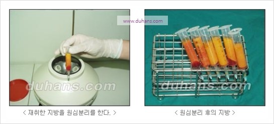 [두한성형외과 경쟁력 코성형] - [코를 높히는 지방이식] 관련 이미지 6