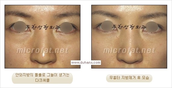 [두한성형외과 경쟁력 눈밑성형] - [과도한 눈밑지방제거의 부작용 후 눈밑지방재배치] 관련 이미지 18