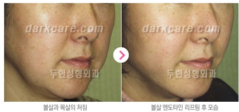 Duhan Plastic Surgery Combo Program - Dark Circles and Lifting image 15