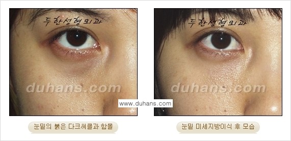 [두한성형외과 상큼하고 환한 눈매완성] - [눈밑 미세지방이식 ②] 관련 이미지 4