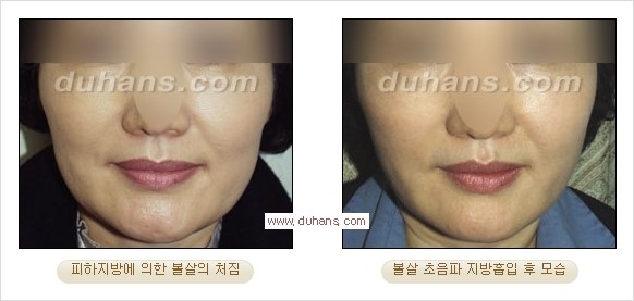 [두한성형외과 경쟁력 지방흡입] - [얼굴, 볼살, 턱살, 턱선의 초음파 지방흡입] 관련 이미지 23