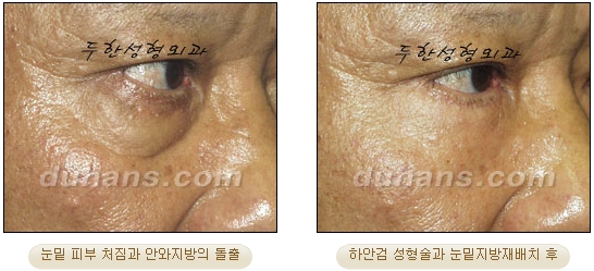 [Duhan Plastic Surgery Ophthalmic Plastic Surgery] - [Lower Blepharoplasty] image 19