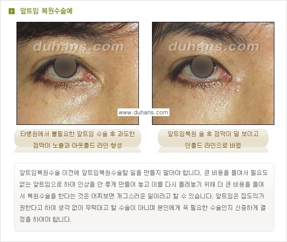 [두한성형외과 No.1 경쟁력] - [앞트임 복원 수술, 뒤트임 복원 수술] 관련 이미지 5