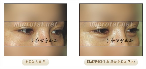 [두한성형외과 경쟁력 지방이식 리더] - [Col-fat(콜펫)지방이식, 3차원 입체지방이식, 2차원 평면지방이식] 관련 이미지 56