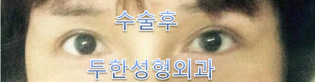 [Duhan Plastic Surgery Double Eyelid Revision] - [Reducing the Double Eyelid Line] image 19