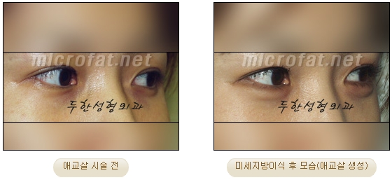 ​[두한성형외과 지방이식] - [애교살] 관련 이미지 6