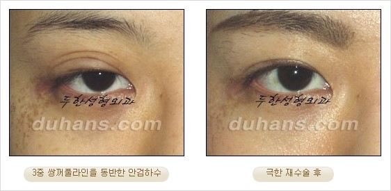 [두한성형외과 경쟁력 쌍꺼풀 재수술 리더 ] - [쌍꺼풀 재수술 과정, 쌍꺼풀 재수술 실패의 원인, 극한 재수술] 관련 이미지 19