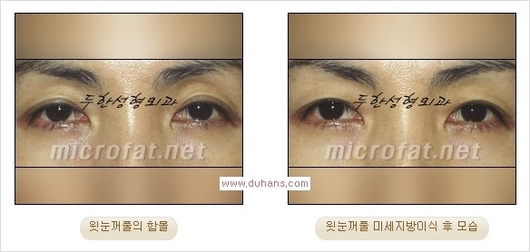 [두한성형외과 Dr. 컬럼] - [눈꺼풀의 지방이식] 관련 이미지 11
