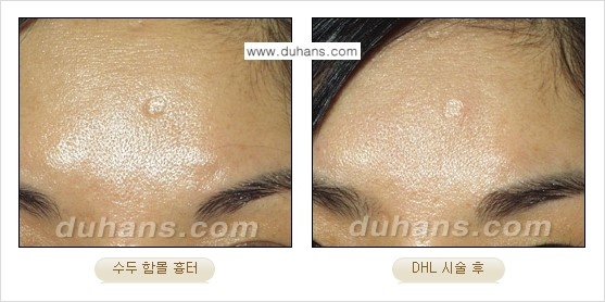 [두한성형외과 함몰 흉터 교정] - [동시에 3가지 시술로 효과적인 흉터의 교정 안내 ②] 관련 이미지 7