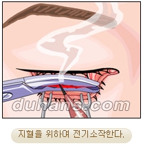 두한성형외과 지방제거 - 눈밑지방, 눈꺼풀지방제거 관련 이미지 17