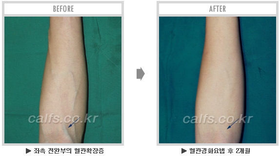 [종아리성형 두한성형외과] - [종아리수술에 대한 자주하는 질문과 답변 모음] 관련 이미지 51