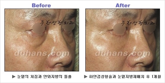 [두한성형외과 경쟁력 동안성형 리더] - ​[미간주름, 이마주름, 안검성형, 이마거상술, 눈썹거상술] 관련 이미지 93