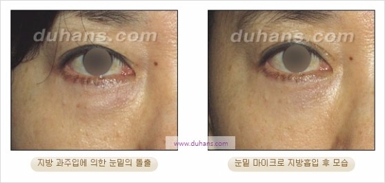 [두한성형외과 경쟁력 지방흡입] - [볼살, 턱선의 간편 지방흡입] 관련 이미지 32