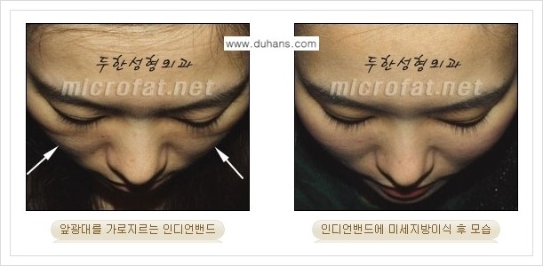[두한성형외과 경쟁력 미세지방이식] - [귀족수술과 인디언밴드 교정 안내] 관련 이미지 15