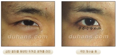 [Special Double Eyelid Revision Surgery at Duhan Plastic Surgery] - [Restorative Surgery for Damaged Double Eyelid Eye Shape] image 17