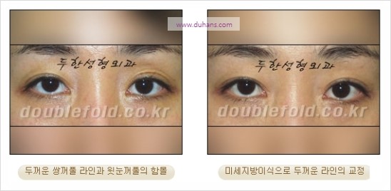 [두한성형외과 경쟁력 눈성형] - [쌍꺼풀 재수술 과정과 쌍꺼풀 재수술 실패의 원인, 쌍꺼풀 재수술의 성공 요건] 관련 이미지 30